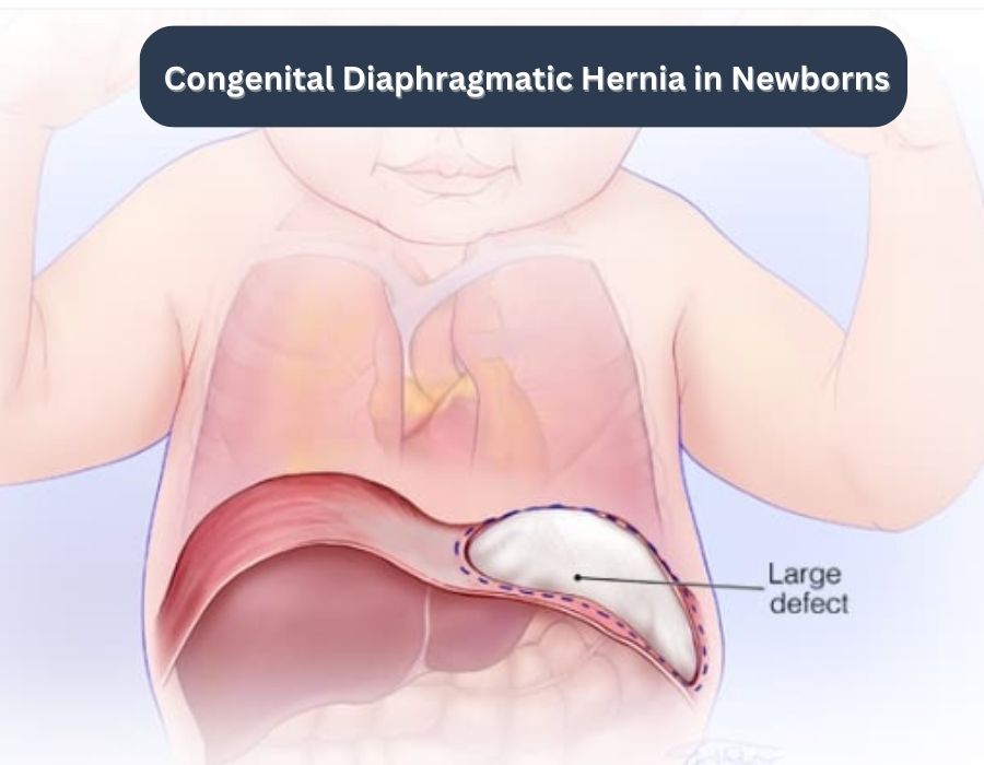 Congenital diaphragmatic hernia in newborns