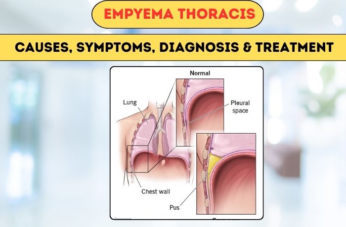 Empyema Thoracis: Causes, Symptoms, & Treatment