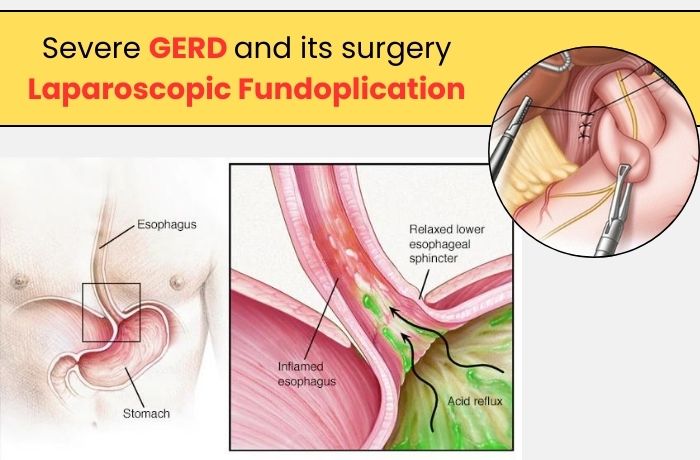 Severe GERD" and its surgery "Laparoscopic Fundoplication