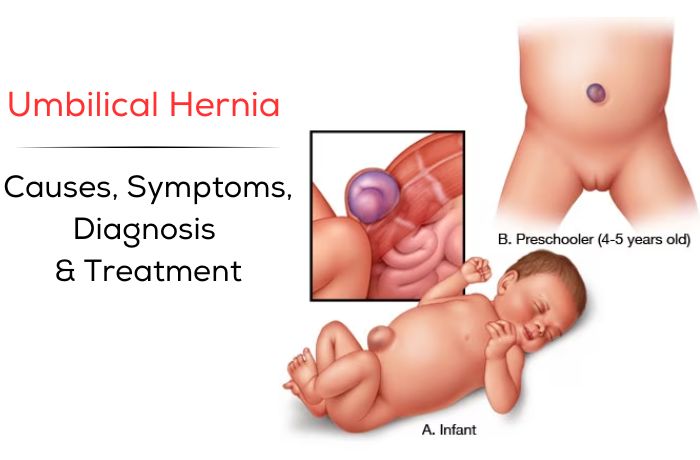 Umbilical Hernia: Causes, Symptoms, Diagnosis & Treatment