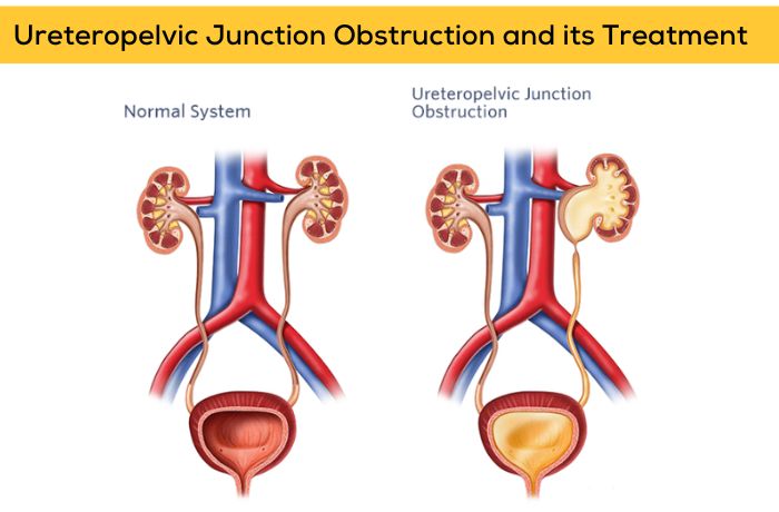 Ureteropelvic Junction Obstruction and its Treatment