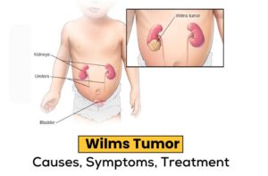 Wilms Tumor: Causes, Symptoms, Treatment