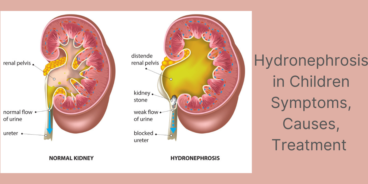 Hydronephrosis in Children: Symptoms, Causes, and Treatment