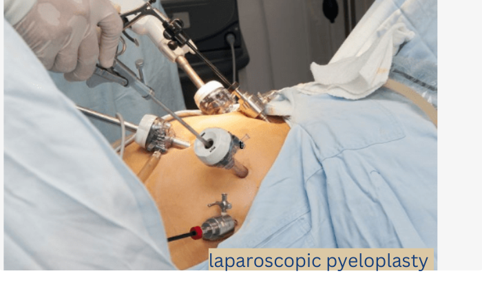 laparoscopic pyeloplasty