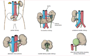 kidney and UT anomalies