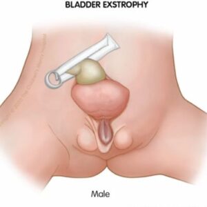 Bladder Exstrophy