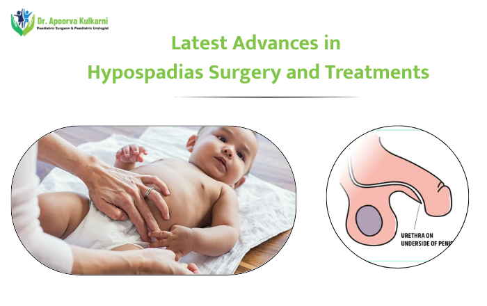 Latest Advances in Hypospadias Surgery and Treatments