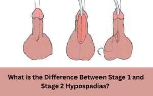 What is the Difference Between Stage 1 and Stage 2 Hypospadias?