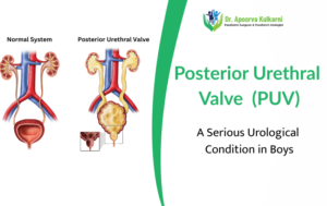 Posterior Urethral Valve (PUV): A Serious Urological Condition in Boys