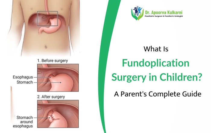 What Is Fundoplication Surgery in Children? A Parent's Complete Guide