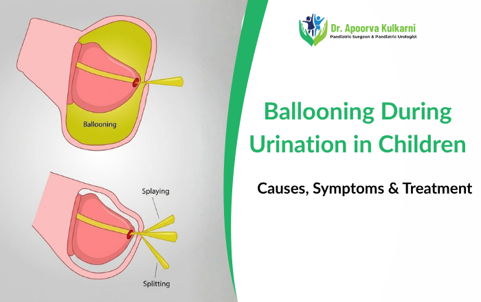 Ballooning During Urination in Children Causes, Symptoms & Treatment