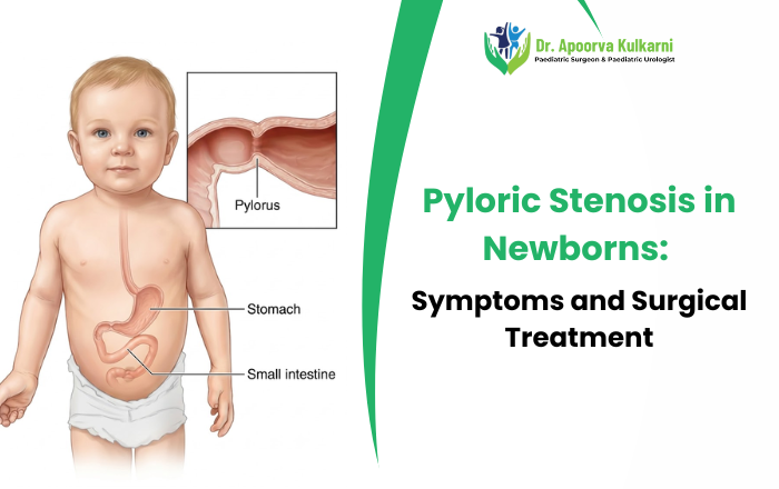 Pyloric Stenosis in Newborns Symptoms and Surgical Treatment